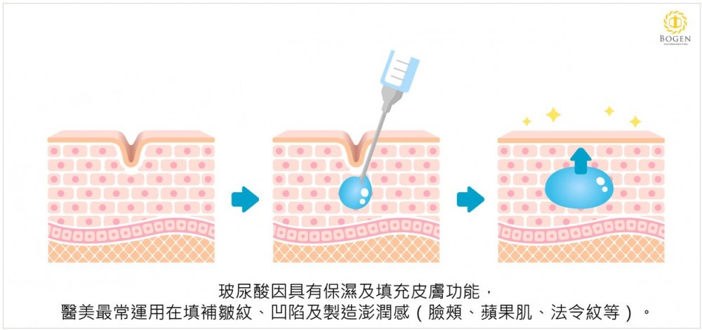 玻尿酸注射,玻尿酸填補,玻尿酸,博恩妍