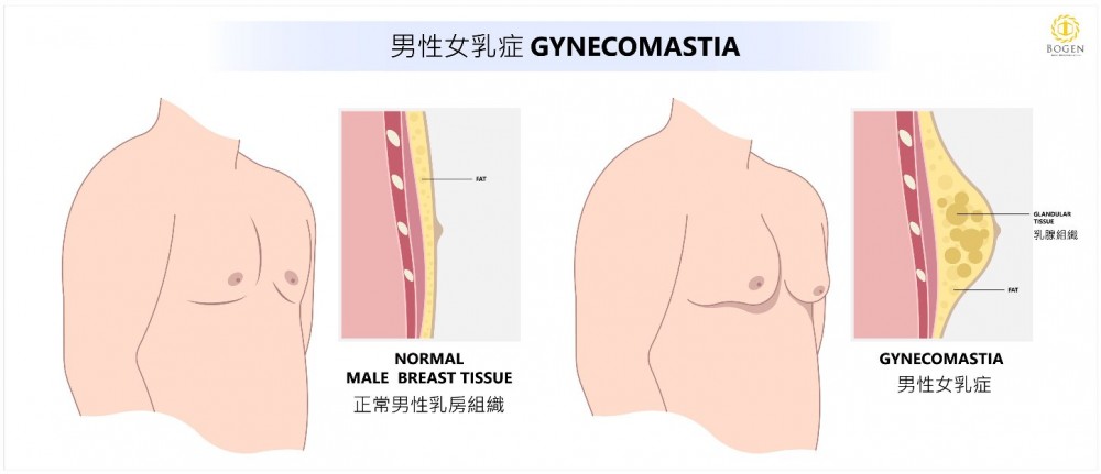 男性女乳症分類,脂肪堆積,乳腺增生,博恩妍