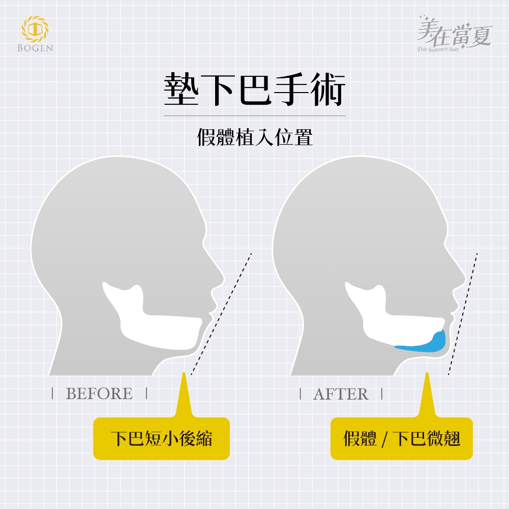 墊下巴手術,下巴手術,下巴整形,墊下巴,下巴,許修銨醫師,博恩妍