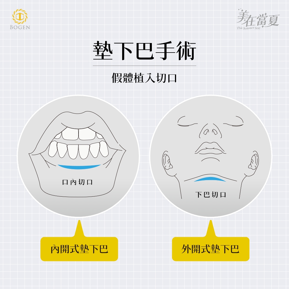 墊下巴手術切口位置,外開式墊下巴,內開式墊下巴,墊下巴手術,墊下巴,下巴手術,博恩妍
