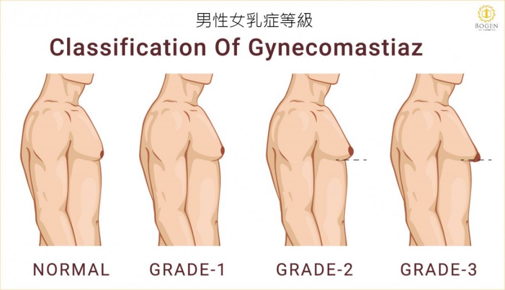 男性女乳症判斷,男性女乳症評估,男性女乳症等級,男性女乳症,博恩妍