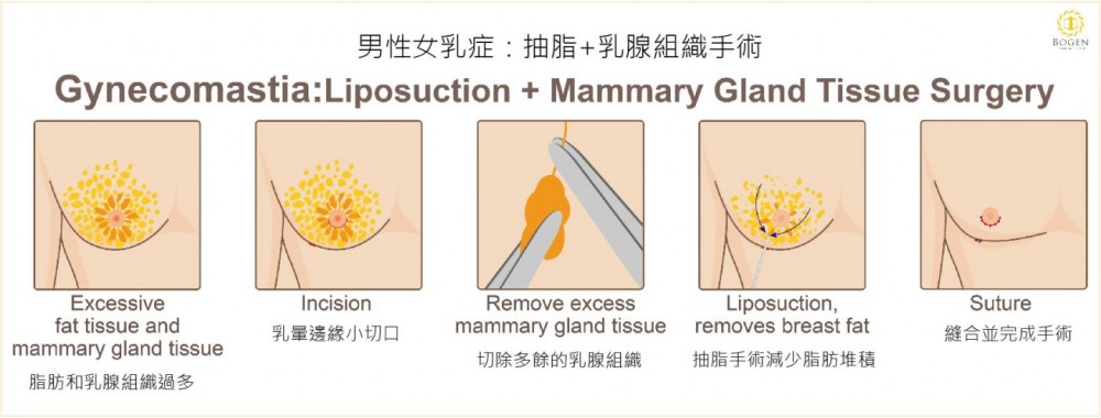 男性女乳症抽脂流程,男性女乳症抽脂,男性女乳症手術,博恩妍