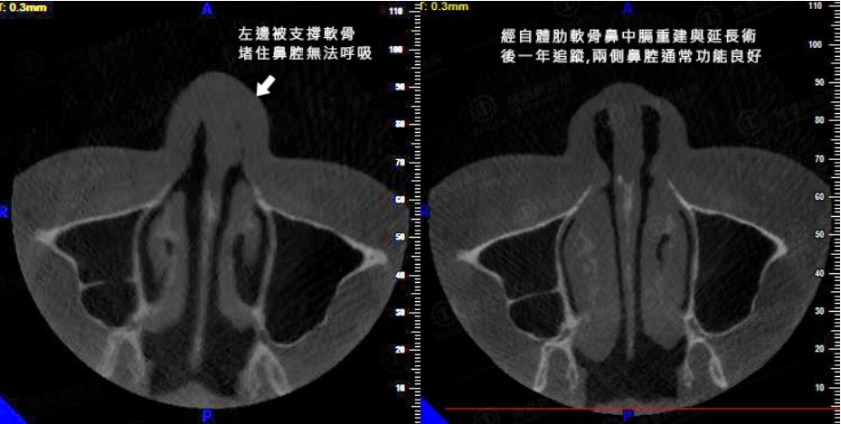 隆鼻會造成鼻塞,隆鼻鼻塞,隆鼻,博恩妍