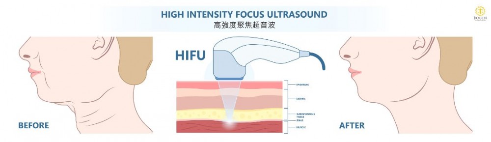 UTIMS彩蝶音波治療原理,超音波拉提,彩蝶音波,博恩妍