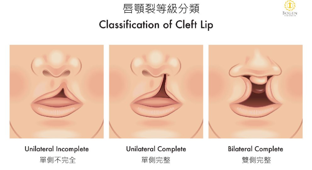 唇顎裂等級分類,唇裂鼻重修,唇裂鼻,博恩妍