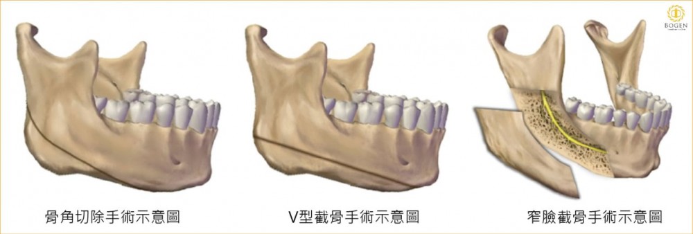 削骨手術分三種,削骨手術,削骨,博恩妍