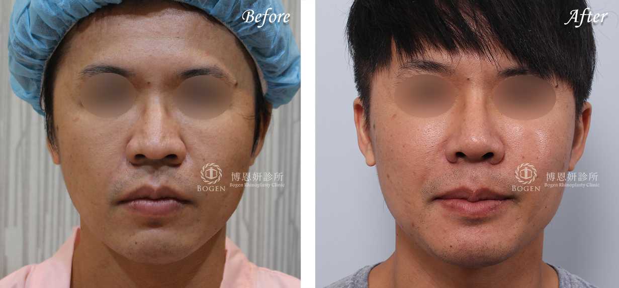 縮鼻翼推薦博恩妍診所張簡醫師縮鼻翼權威