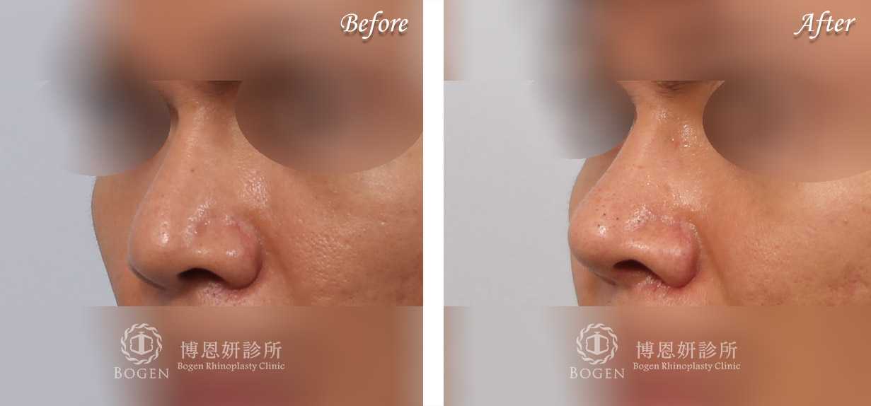 縮鼻翼推薦博恩妍診所張簡醫師縮鼻翼權威
