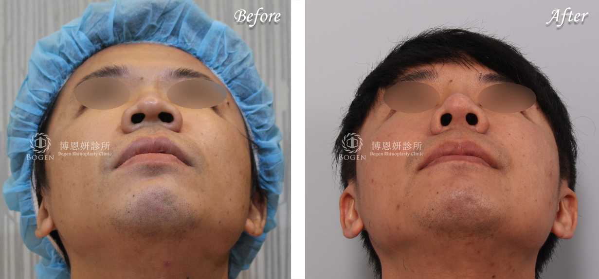 縮鼻翼推薦博恩妍診所張簡醫師縮鼻翼權威