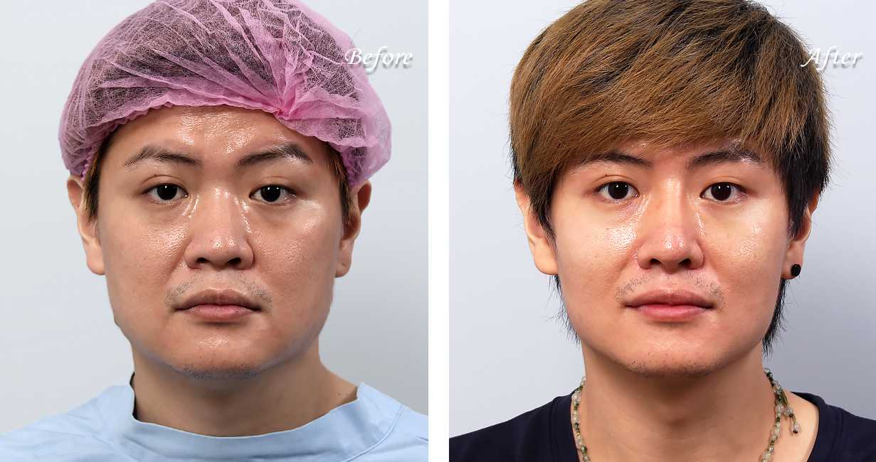 博恩妍診所縮鼻翼推薦張簡醫師縮鼻翼權威