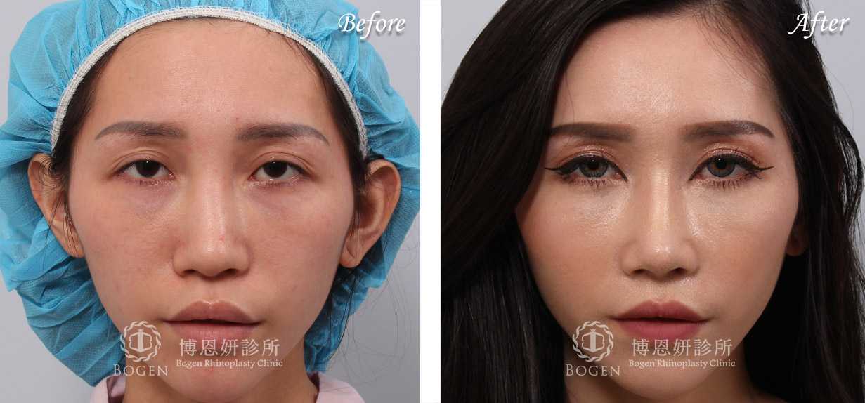 鼻整形術前術後照鼻整形案例12,鼻整形手術推薦博恩妍診所張簡醫師