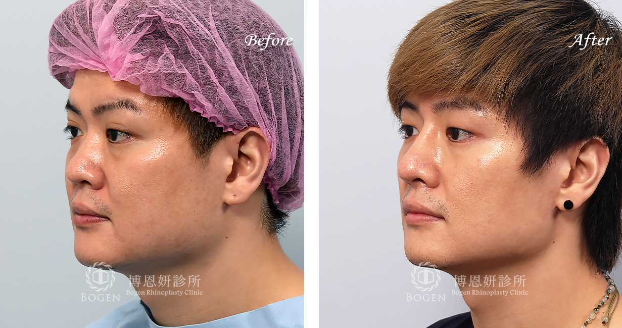 男性鼻整形術前術後照鼻整形案例20,鼻整形手術推薦博恩妍診所張簡醫師