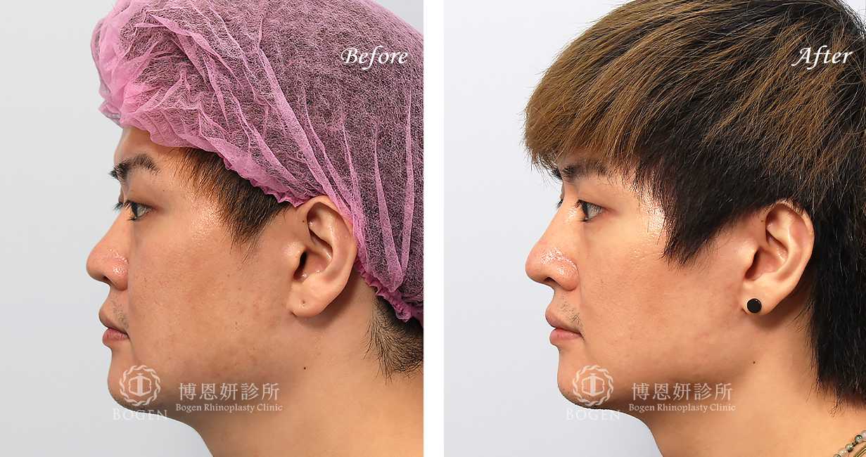 博恩妍診所縮鼻翼推薦張簡醫師縮鼻翼權威