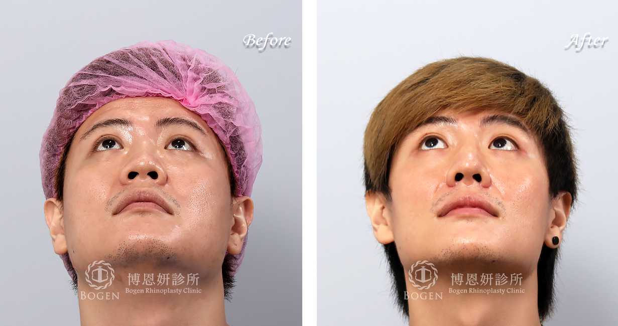 博恩妍診所縮鼻翼推薦張簡醫師縮鼻翼權威