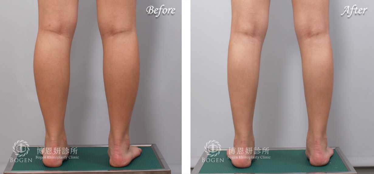 小腿抽脂改善脂肪堆積問題