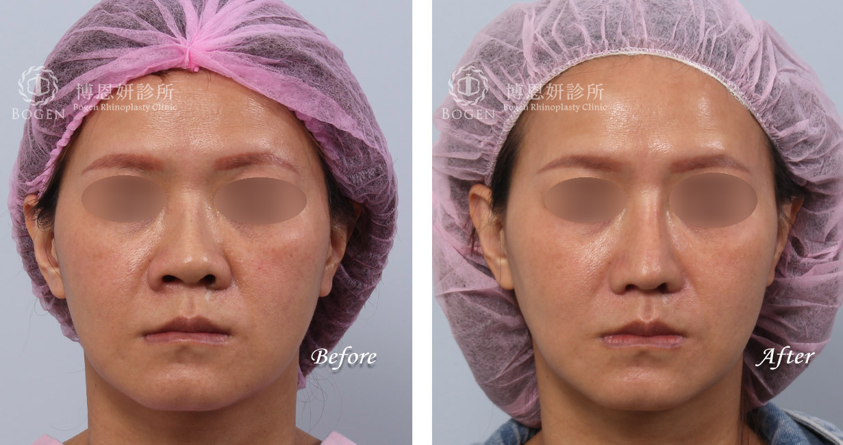 縮鼻翼權威張簡醫師幫你解決鼻翼過大問題，縮鼻翼給你秀氣精緻的鼻形。