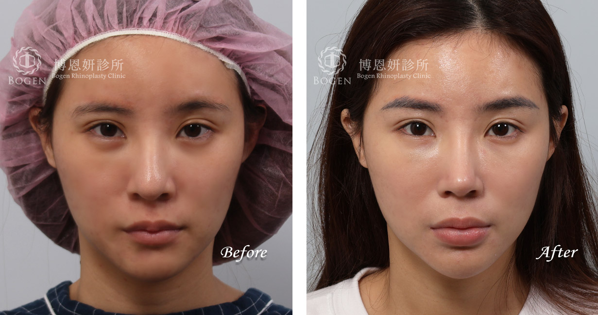 縮鼻翼手術推薦：博恩妍診所，縮鼻翼權威，張簡醫師