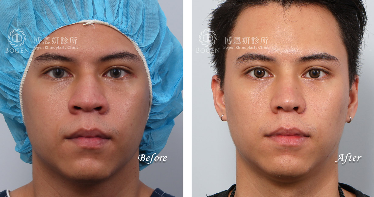 男性隆鼻/無假體異體真皮隆鼻/縮鼻翼/海鷗線