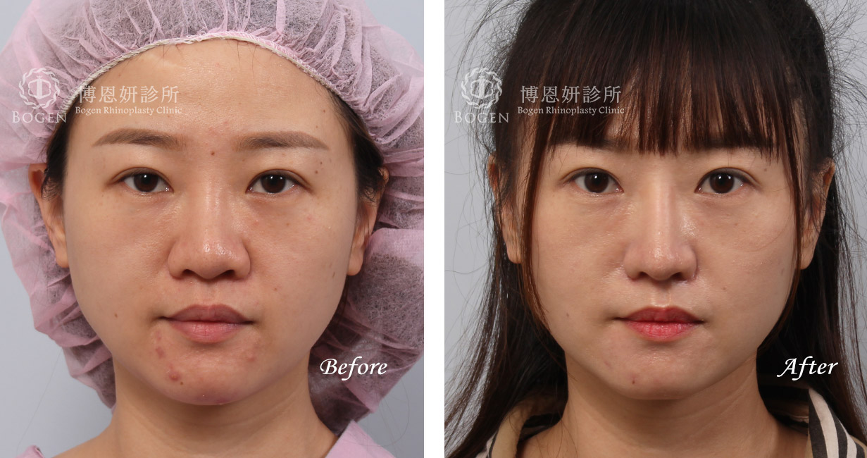縮鼻翼術前術後照：博恩妍診所張簡醫師縮鼻翼權威