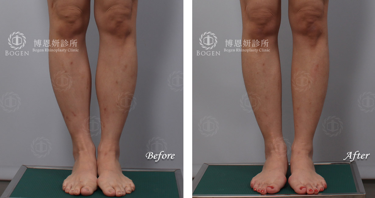 小腿抽脂+小腿肉毒