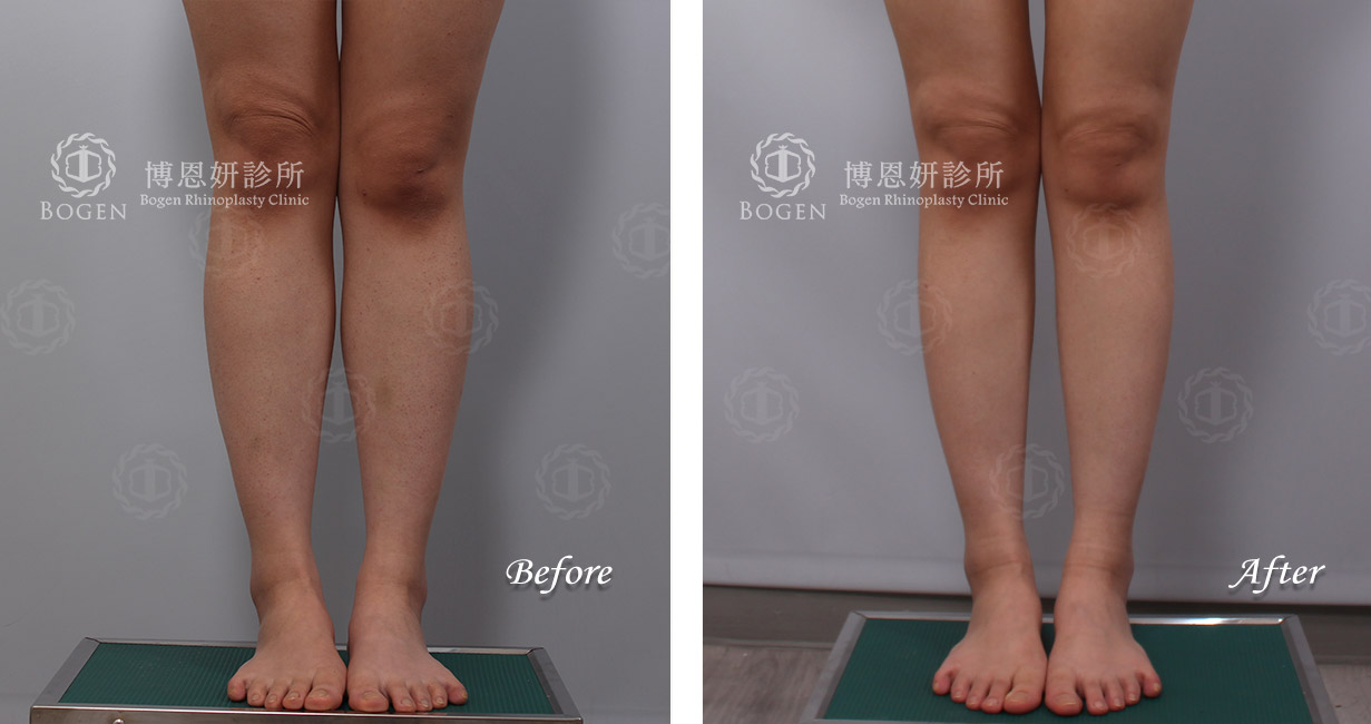 小腿抽脂+小腿肉毒