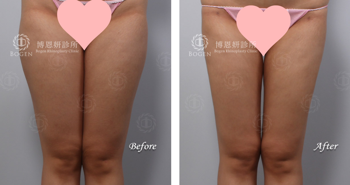 大腿環抽