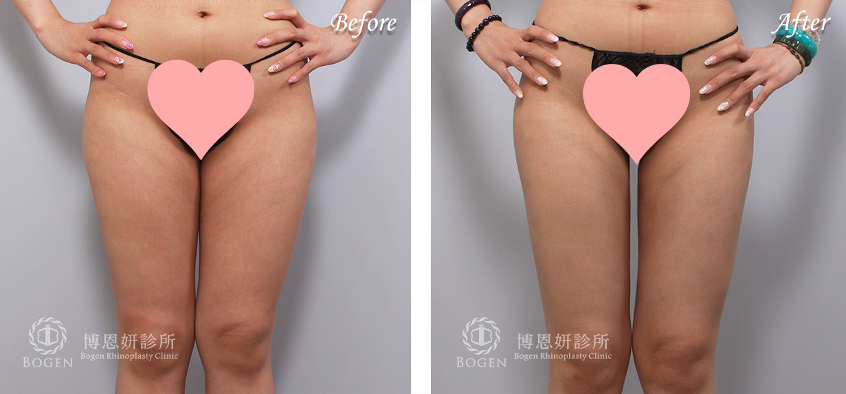 威塑抽脂改善馬鞍肉與大腿脂肪堆積。
