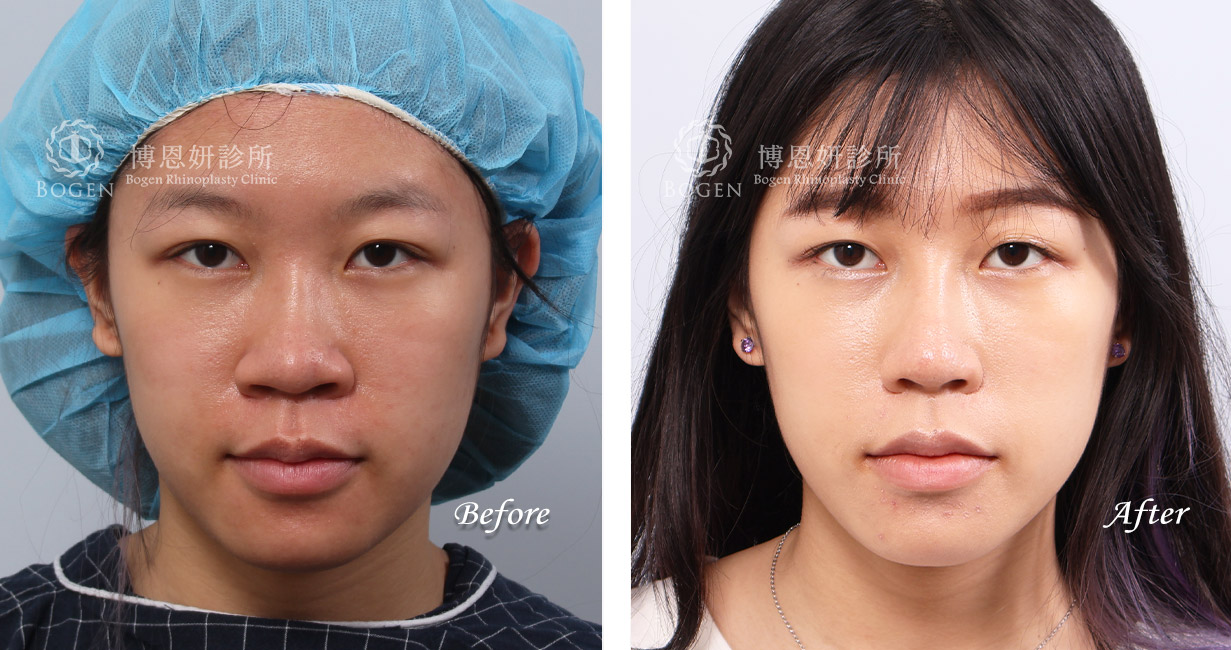 縮鼻翼推薦張簡醫師(縮鼻翼權威)