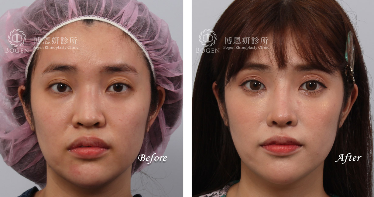 縮鼻翼手術推薦－博恩妍診所（張簡醫師）縮鼻翼權威
