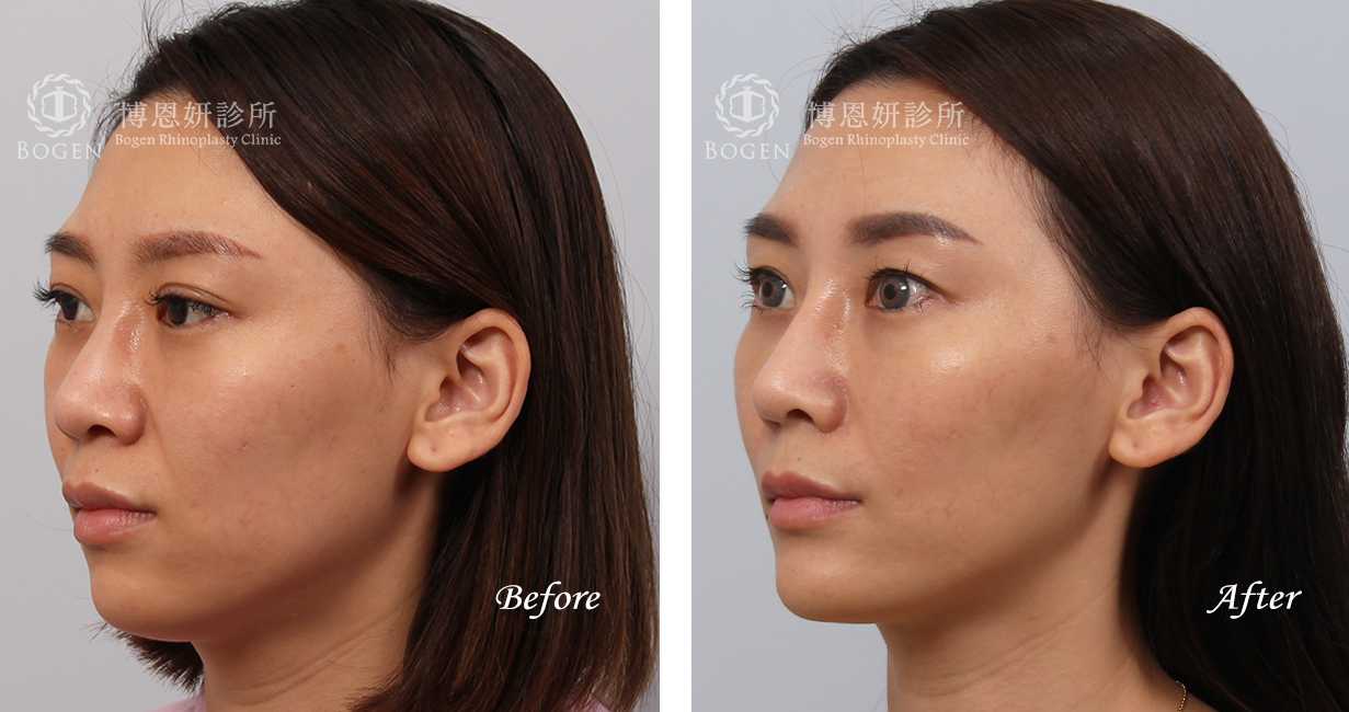 張簡醫師縮鼻翼權威，縮鼻翼術前術後照片