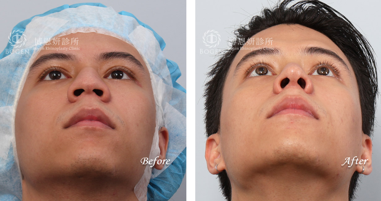 男性隆鼻/無假體異體真皮隆鼻/縮鼻翼/海鷗線