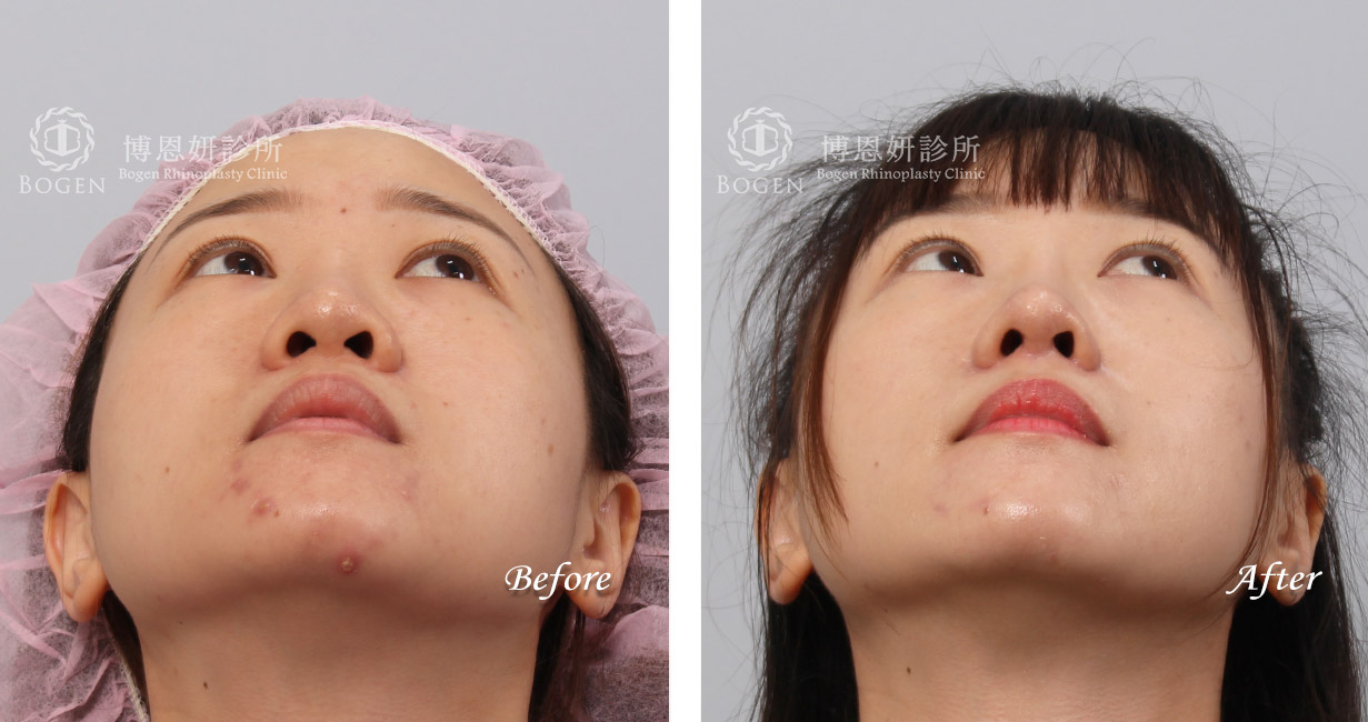 縮鼻翼術前術後照：博恩妍診所張簡醫師縮鼻翼權威