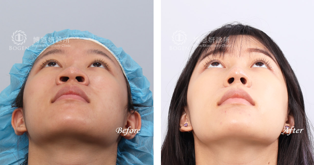 縮鼻翼推薦張簡醫師(縮鼻翼權威)