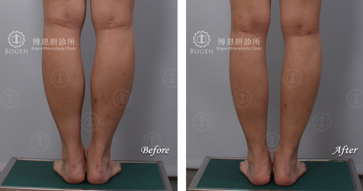小腿抽脂+小腿肉毒