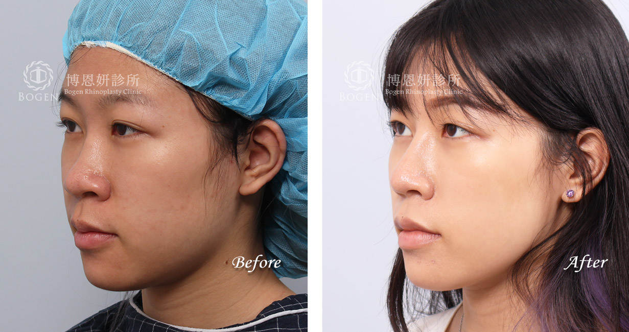 縮鼻翼推薦張簡醫師(縮鼻翼權威)