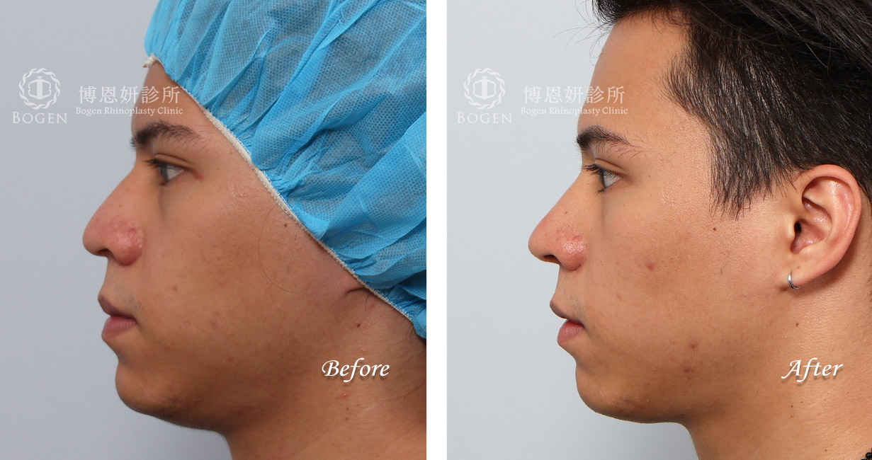 男性隆鼻/無假體異體真皮隆鼻/縮鼻翼/海鷗線