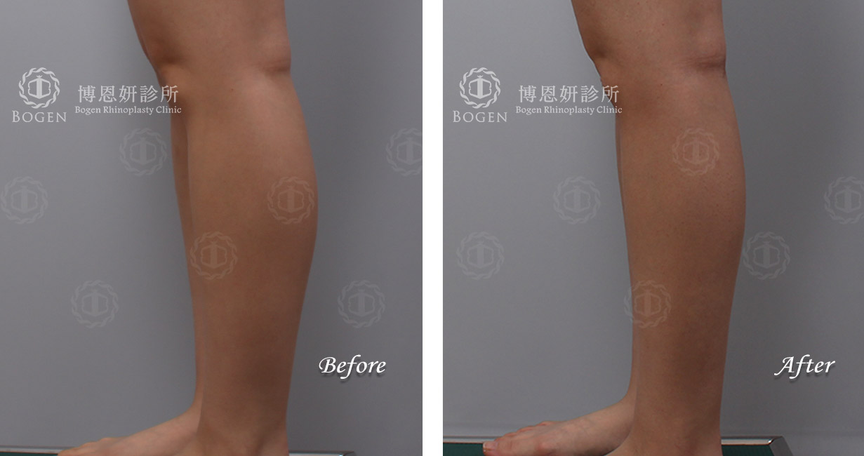 小腿抽脂改善脂肪堆積問題