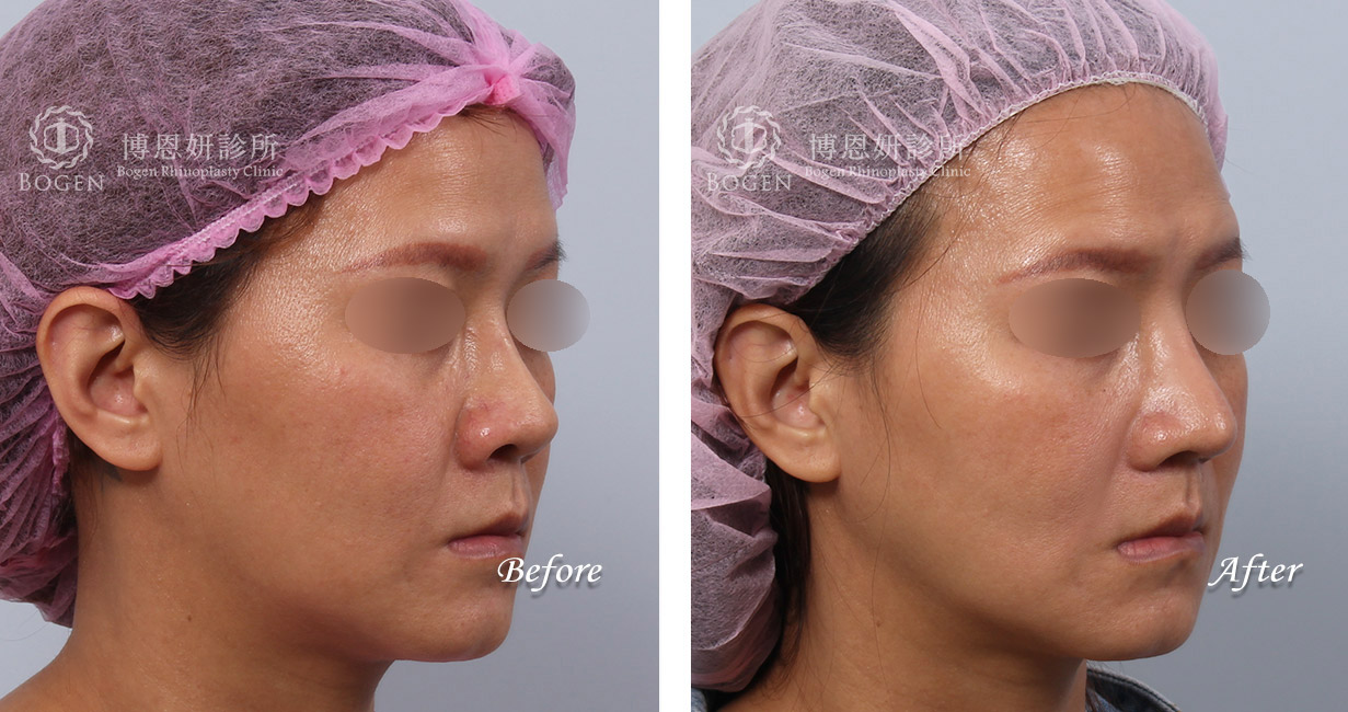 縮鼻翼權威張簡醫師幫你解決鼻翼過大問題，縮鼻翼給你秀氣精緻的鼻形。