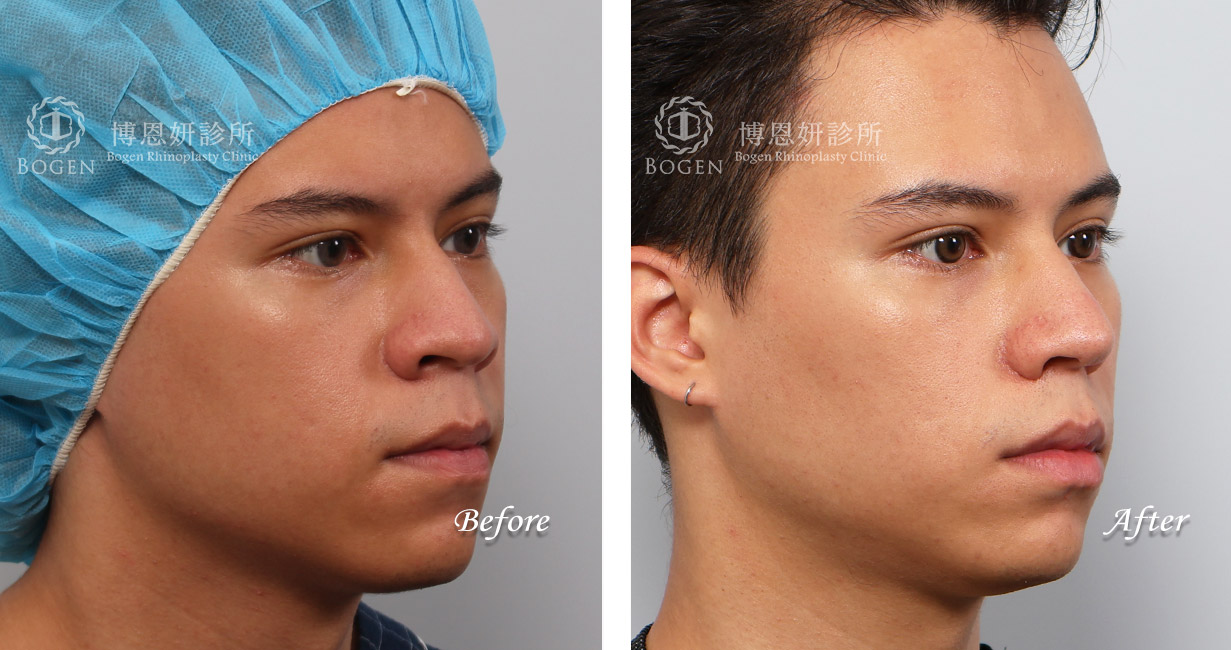 男性隆鼻/無假體異體真皮隆鼻/縮鼻翼/海鷗線