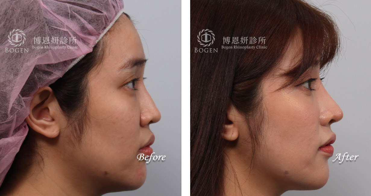 縮鼻翼手術推薦－博恩妍診所（張簡醫師）縮鼻翼權威