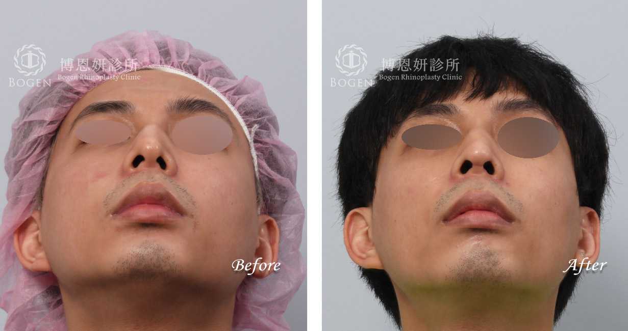 男鼻整形,隆鼻男性,鼻整形無假體異體真皮隆鼻,縮鼻翼鼻整形,海鷗線鼻整形