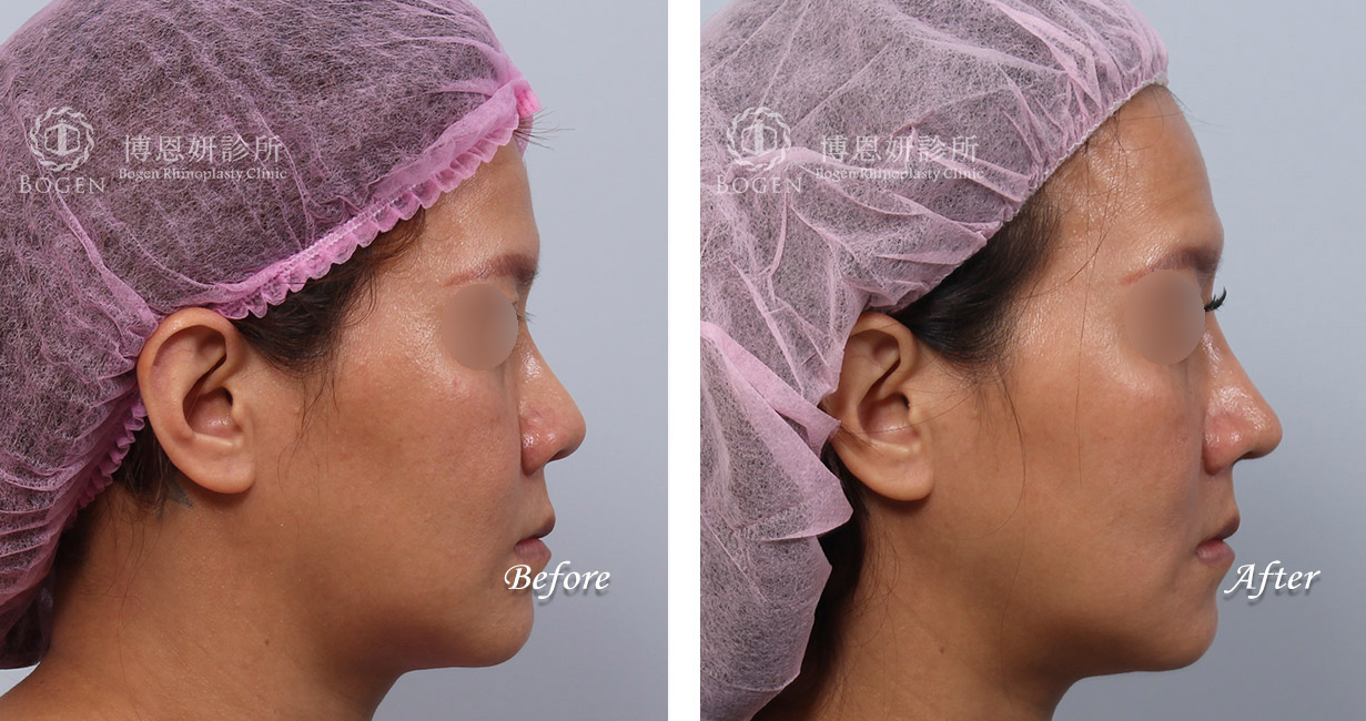 縮鼻翼權威張簡醫師幫你解決鼻翼過大問題，縮鼻翼給你秀氣精緻的鼻形。