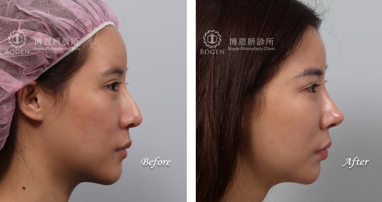縮鼻翼手術推薦：博恩妍診所，縮鼻翼權威，張簡醫師