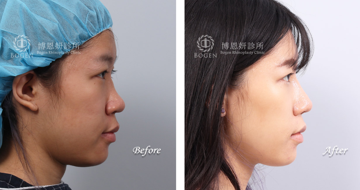 縮鼻翼推薦張簡醫師(縮鼻翼權威)