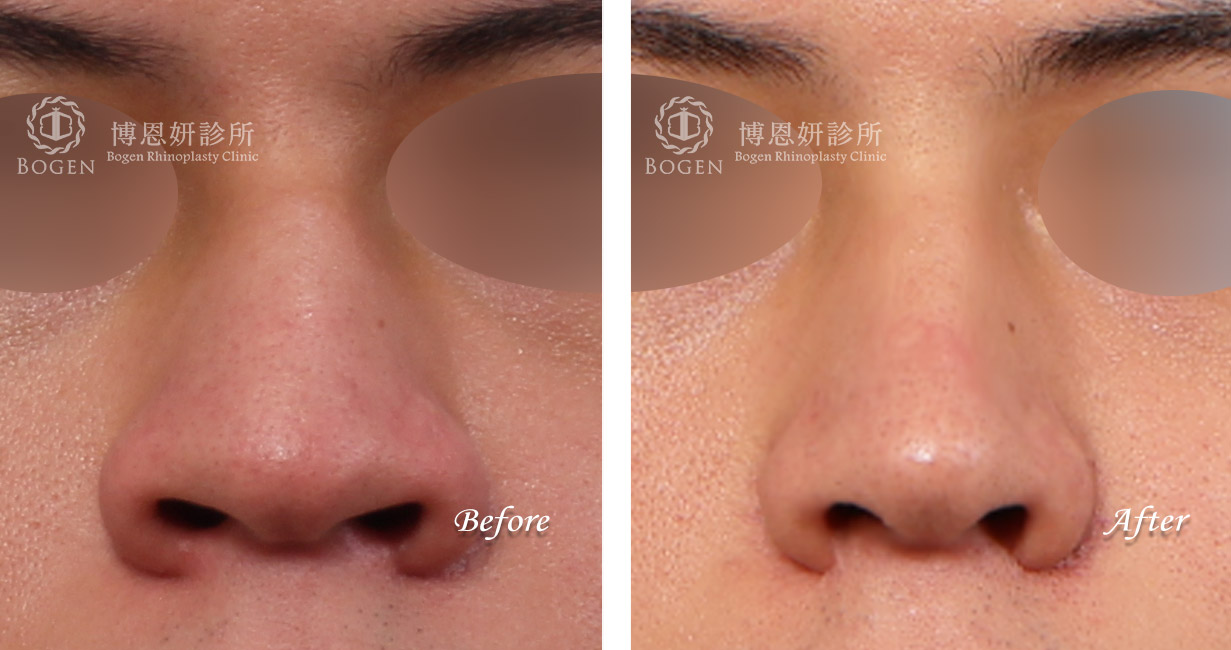 縮鼻翼推薦,男性隆鼻,無假體異體真皮隆鼻,縮鼻翼,海鷗線,張簡醫師縮鼻翼權威